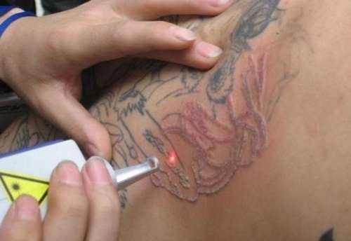 Уникальная методика удаления татуировок лазером