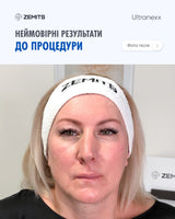 Zemits Ultranexx Аппарат SMAS лифтинга HIFU для подтяжи лица и тела