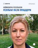 Zemits Ultranexx Аппарат SMAS лифтинга HIFU для подтяжи лица и тела
